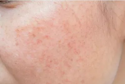 雀斑和黄褐斑什么区别