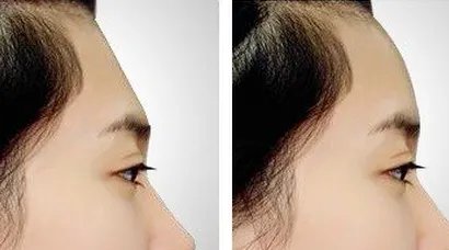 玻尿酸丰额头有什么优势