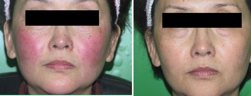 如何去除面部红血丝