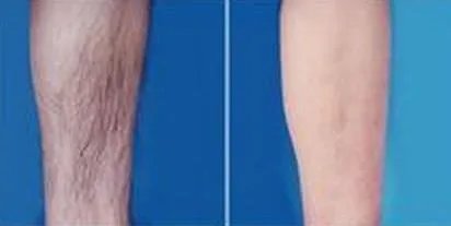 小腿激光脱毛的价格