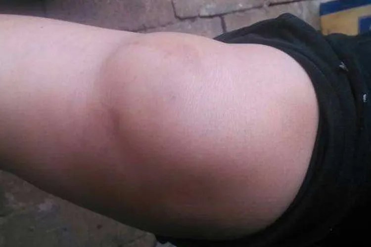 小孩膝盖外侧骨头突出图片