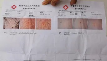 呼和浩特幼儿园多名孩子被扎针眼一事的调查结果是什么?