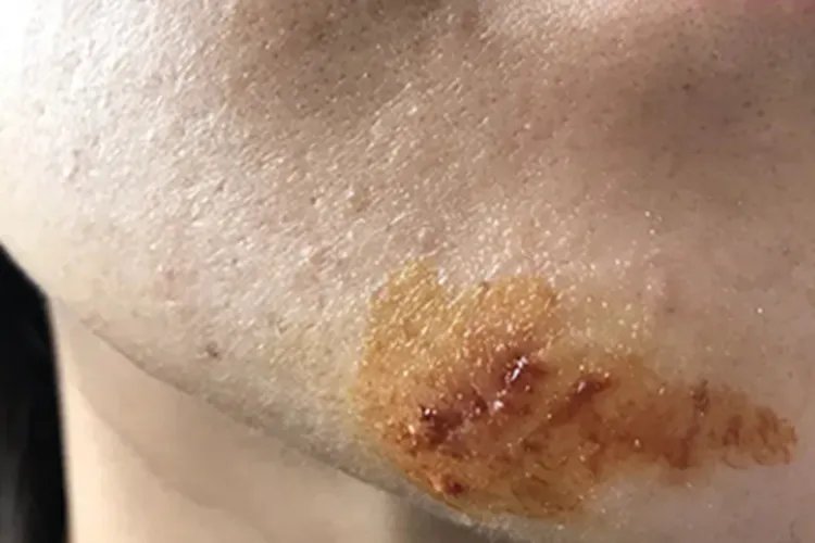 切痣恢复过程图