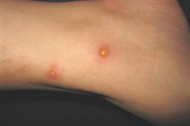 丘疹性荨麻疹脚踝症状图片