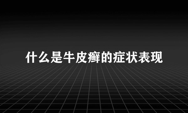 什么是牛皮癣的症状表现