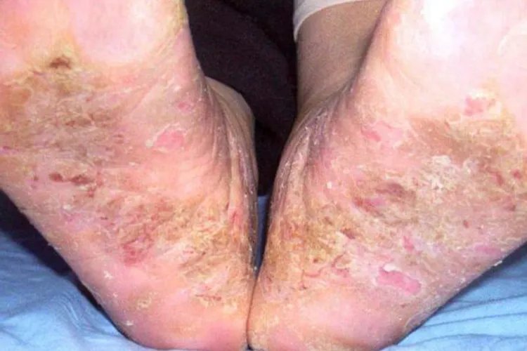 脚上皮肤病图片
