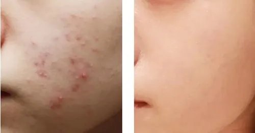 做祛痘需要多少钱？费用是多少？