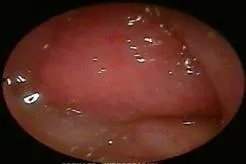 小孩腺样体肥大图片