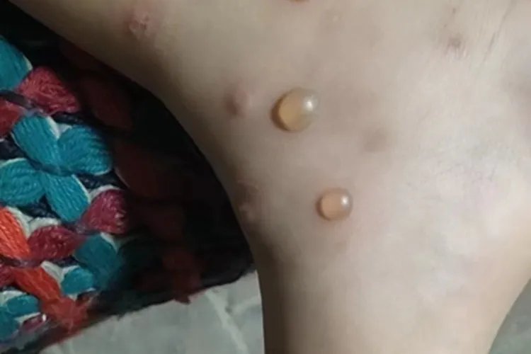 丘疹性荨麻疹脚踝症状图片