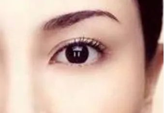 双眼皮做宽了能修复吗