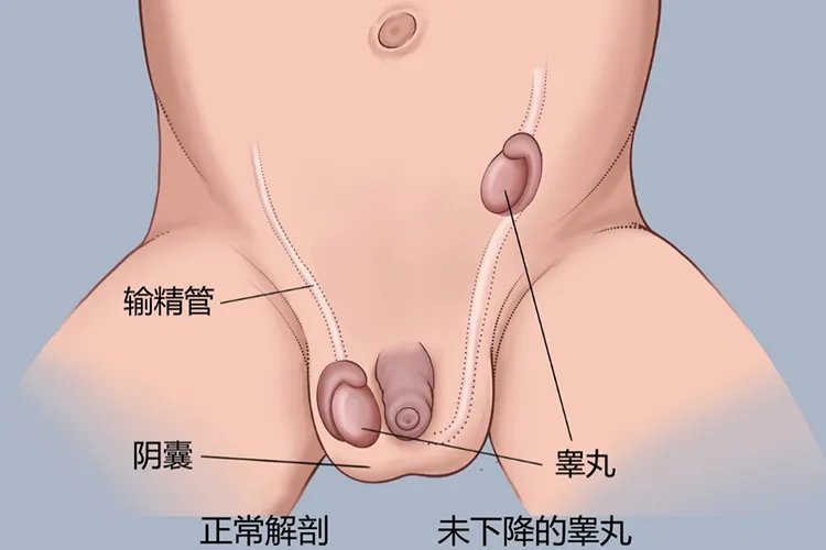 新生儿男孩睾丸一大一小图片