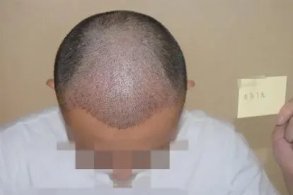 植发3500单位效果图