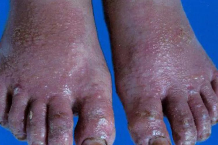 脚上皮肤病图片