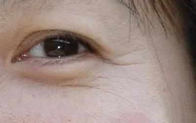 怎么去除眼角皱纹