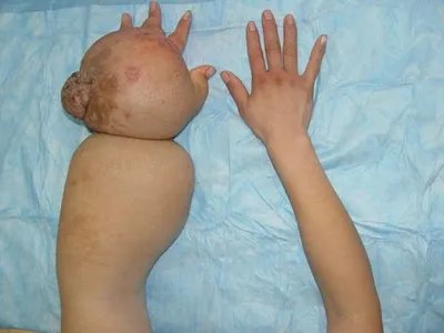 淋巴丝虫病手部症状图片