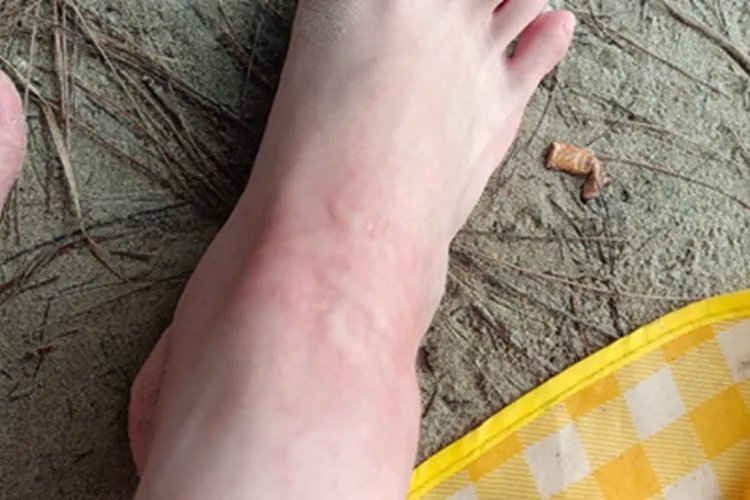 海蜇蜇伤脚背症状图片