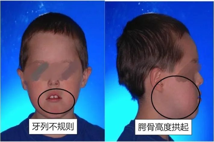 小孩腺样体肥大图片