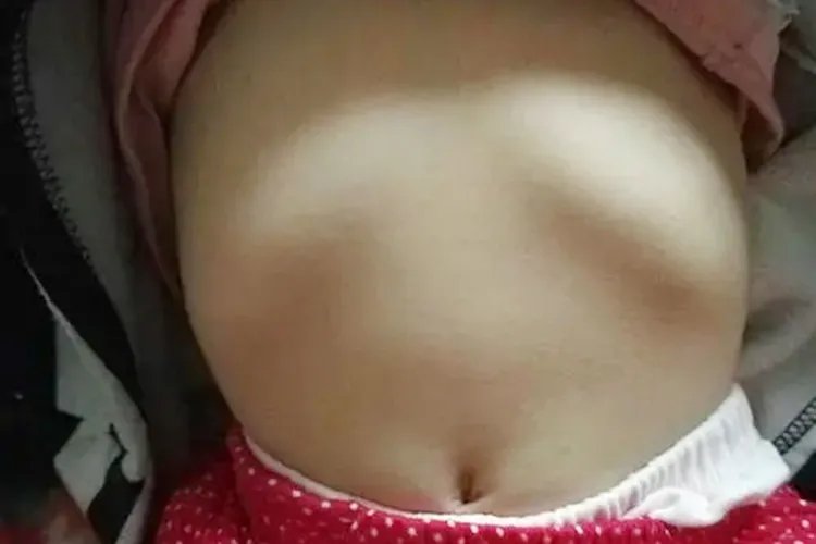 轻微佝偻病的症状图片