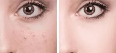 做祛痘需要多少钱？费用是多少？