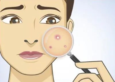 做祛痘需要多少钱？费用是多少？