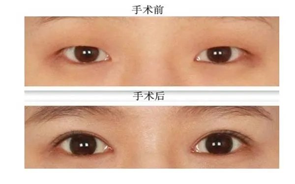 北京哪割双眼皮