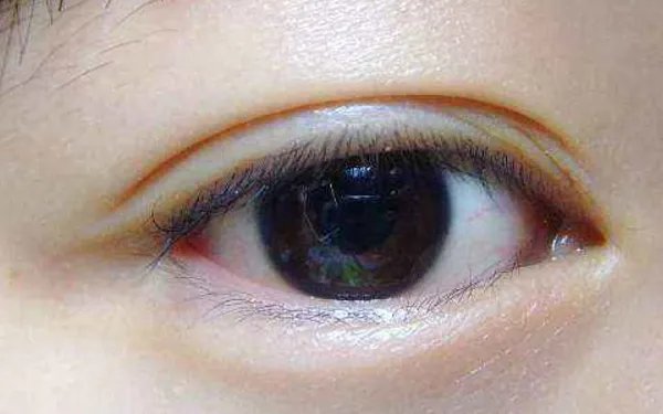 北京割双眼皮手术多少钱呢