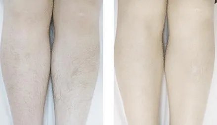 冰点脱毛的副作用