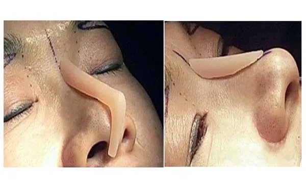 广州玻尿酸隆鼻医院哪里比较好