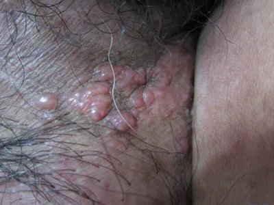 皮肤转移癌丘疹图片