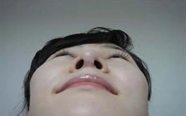 广州玻尿酸隆鼻医院哪里比较好