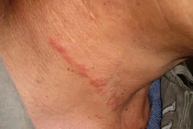 脖子颈纹红痒像勒痕图片