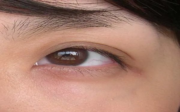 重庆韩式三点双眼皮去哪家医院好