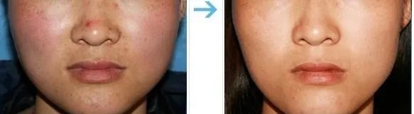 怎么去红血丝最有效