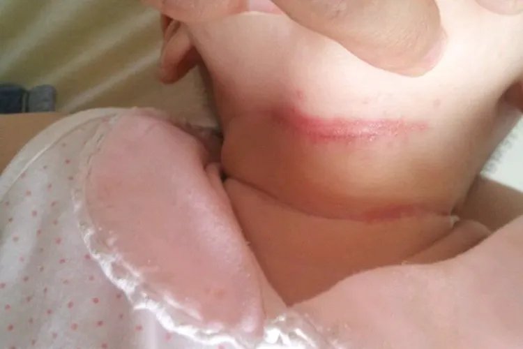 脖子颈纹红痒像勒痕图片