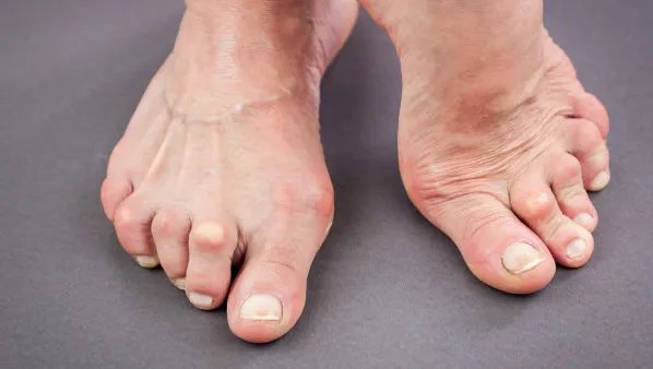 风湿病怎么治疗