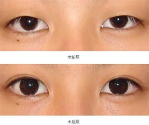 双眼皮哪种好