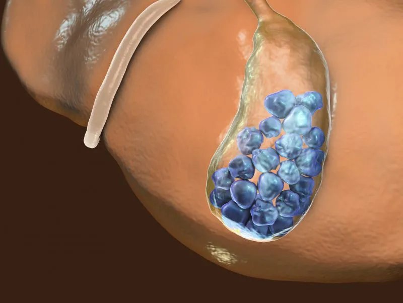结石病人不能吃什么
