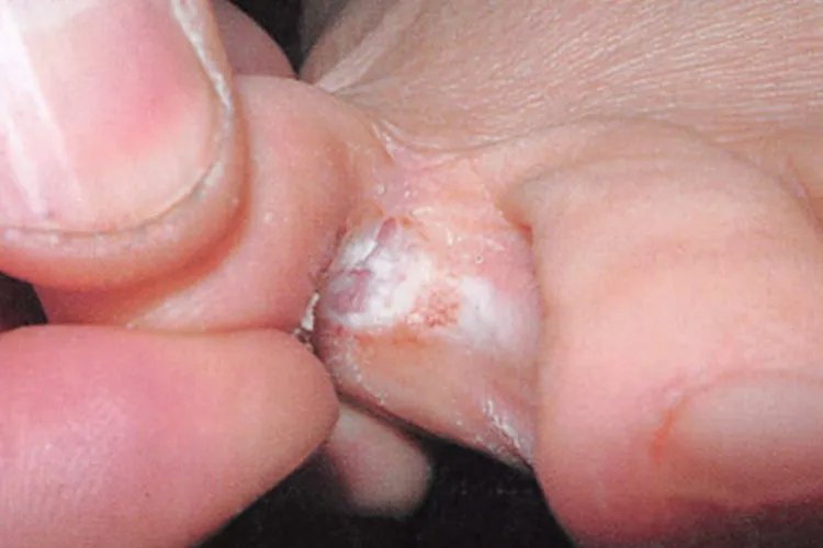 脚上皮肤病图片