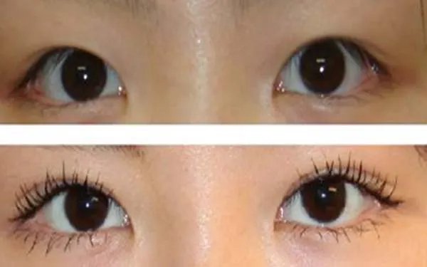 北京做双眼皮哪家医院好？