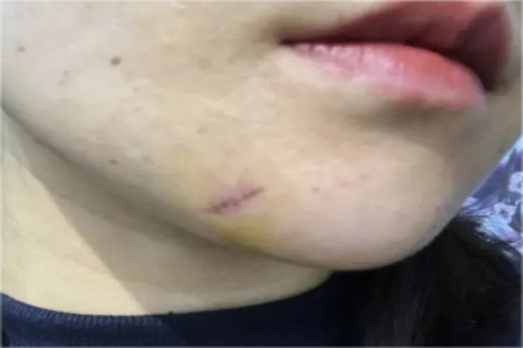 切痣恢复过程图