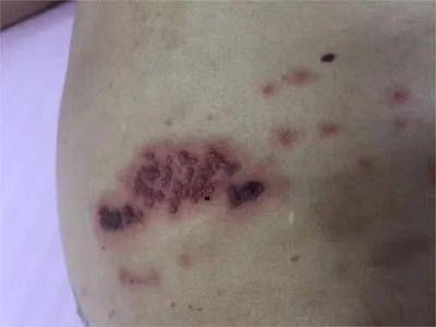 皮肤转移癌丘疹图片