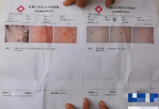 呼和浩特幼儿园多名孩子被扎针眼一事的调查结果是什么?