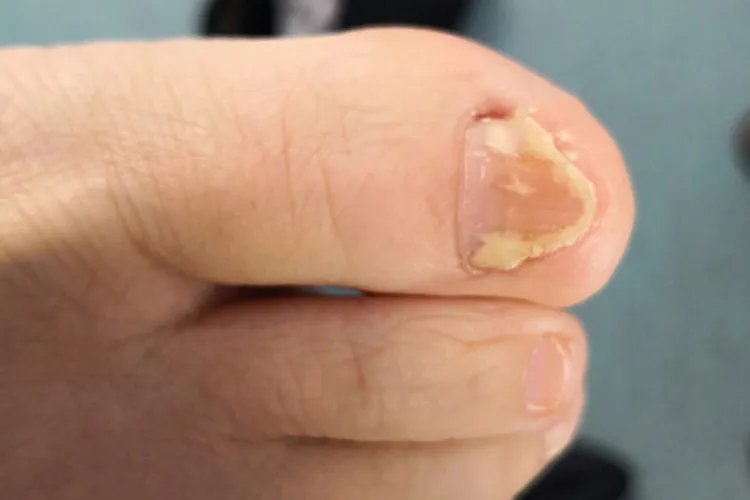 灰指甲图片治疗方法