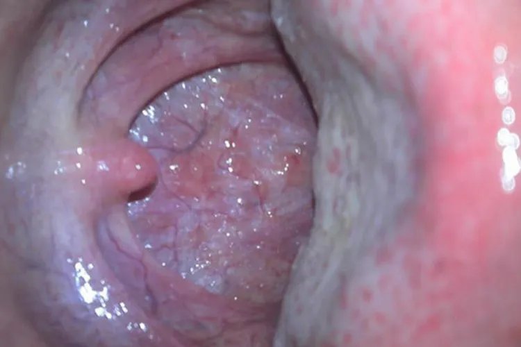 扁桃体和咽喉炎区分图