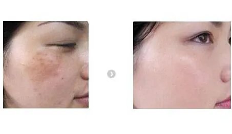 激光祛斑手术多少钱