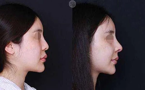 整鼻子价格多少