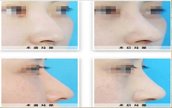 成都隆鼻哪家医院好