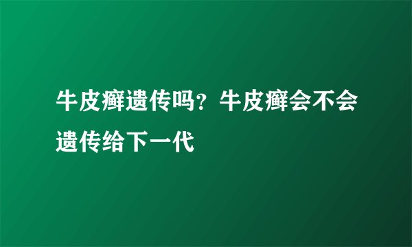牛皮癣遗传吗？牛皮癣会不会遗传给下一代