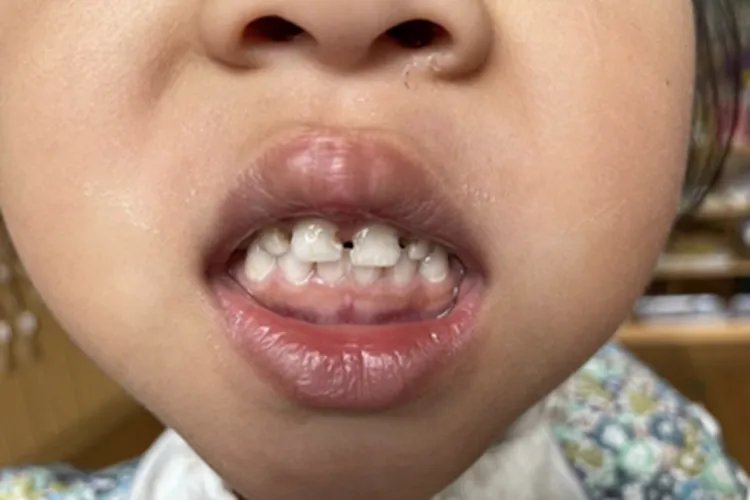 龋病牙齿缺损图片