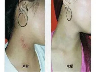 怎么修复凹陷疤痕